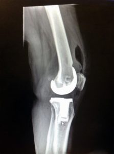 joint replacement